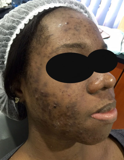 acne scarring