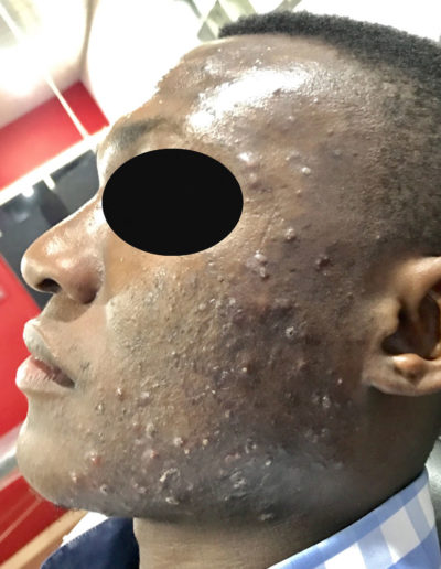 acne scarring black skin