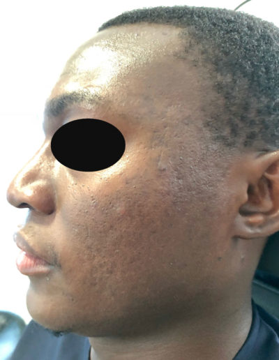 acne scarring black skin
